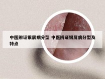 中医辨证银屑病分型 中医辨证银屑病分型及特点