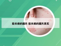 脸长癣的图片 脸长癣的图片真实