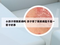 小孩子得银屑病吗 孩子得了银屑病是不是一辈子的事