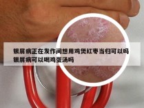 银屑病正在发作间想用鸡煲红枣当归可以吗 银屑病可以喝鸡蛋汤吗