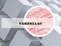 牛皮癣渗液怎么治疗