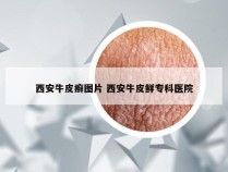 西安牛皮癣图片 西安牛皮鲜专科医院