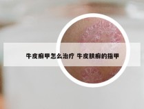 牛皮癣甲怎么治疗 牛皮肤癣的指甲