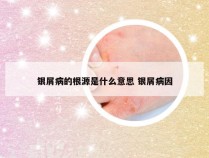 银屑病的根源是什么意思 银屑病因