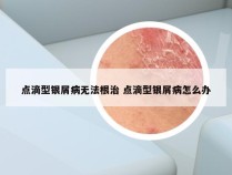 点滴型银屑病无法根治 点滴型银屑病怎么办