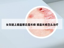 女生腿上膝盖那总是长癣 膝盖长癣怎么治疗