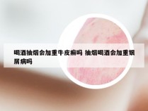 喝酒抽烟会加重牛皮癣吗 抽烟喝酒会加重银屑病吗