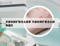 手部白斑扩散怎么回事 手部白斑扩散怎么回事图片