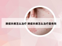 脚底长癣怎么治疗 脚底长癣怎么治疗最有效