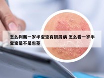 怎么判断一岁半宝宝有银屑病 怎么看一岁半宝宝是不是包茎