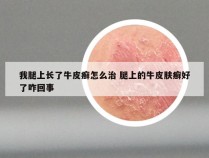 我腿上长了牛皮癣怎么治 腿上的牛皮肤癣好了咋回事