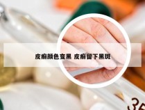 皮癣颜色变黑 皮癣留下黑斑