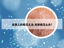 皮肤上的癣怎么治 皮肤癣怎么办?