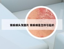 银癣病头发图片 银癣病是怎样引起的