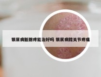 银屑病骶髂疼能治好吗 银屑病髋关节疼痛