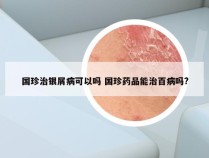 国珍治银屑病可以吗 国珍药品能治百病吗?