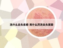 洗什么去头皮癣 用什么药洗去头屑藓