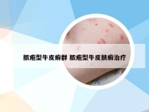 脓疱型牛皮癣群 脓疱型牛皮肤癣治疗