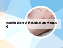 满脑袋都是银屑病 满脑袋都是银屑病怎么治疗