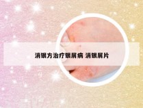 消银方治疗银屑病 消银屑片