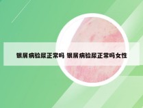 银屑病验尿正常吗 银屑病验尿正常吗女性