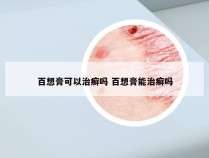 百想膏可以治癣吗 百想膏能治癣吗