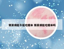 银屑病能不能吃糯米 银屑病能吃糯米吗