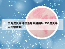 三九皮炎平可以治疗银屑病吗 999皮炎平治疗银屑病