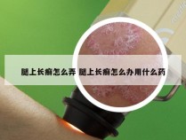 腿上长癣怎么弄 腿上长癣怎么办用什么药