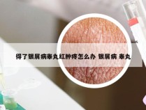 得了银屑病睾丸红肿疼怎么办 银屑病 睾丸