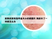 前胸皮肤有指甲盖大小的癣图片 胸前长了一块癣怎么办