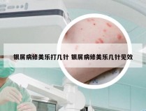 银屑病修美乐打几针 银屑病修美乐几针见效