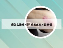 癣怎么治疗才好 癣怎么治才能断根