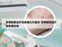 生物制剂治疗皮肤病几针能好 生物制剂治疗皮肤病价格