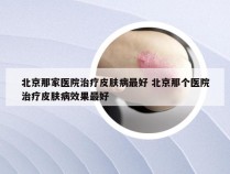 北京那家医院治疗皮肤病最好 北京那个医院治疗皮肤病效果最好