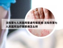 沈阳第七人民医院普通号银屑病 沈阳市第七人民医院治疗银屑病怎么样