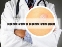 阴囊腹股沟银屑病 阴囊腹股沟银屑病图片