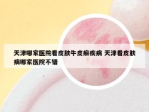 天津哪家医院看皮肤牛皮癣疾病 天津看皮肤病哪家医院不错