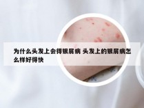 为什么头发上会得银屑病 头发上的银屑病怎么样好得快