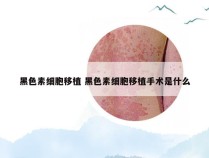 黑色素细胞移植 黑色素细胞移植手术是什么