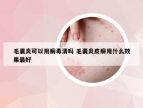 毛囊炎可以用癣毒清吗 毛囊炎皮癣用什么效果最好