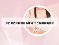 下巴旁边长癣是什么原因 下巴周围长癣图片