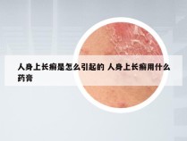 人身上长癣是怎么引起的 人身上长癣用什么药膏