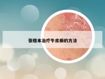 张梧本治疗牛皮癣的方法