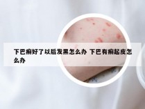 下巴癣好了以后发黑怎么办 下巴有癣起皮怎么办