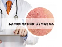 小孩生癣的图片和症状 孩子生癣怎么办