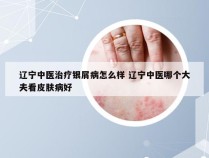 辽宁中医治疗银屑病怎么样 辽宁中医哪个大夫看皮肤病好