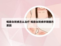 嘴唇白斑病怎么治疗 嘴唇白斑病早期图片 原因