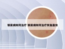 银屑病如何治疗 银屑病如何治疗恢复最快