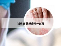 钱币癣 钱币癣用什么药